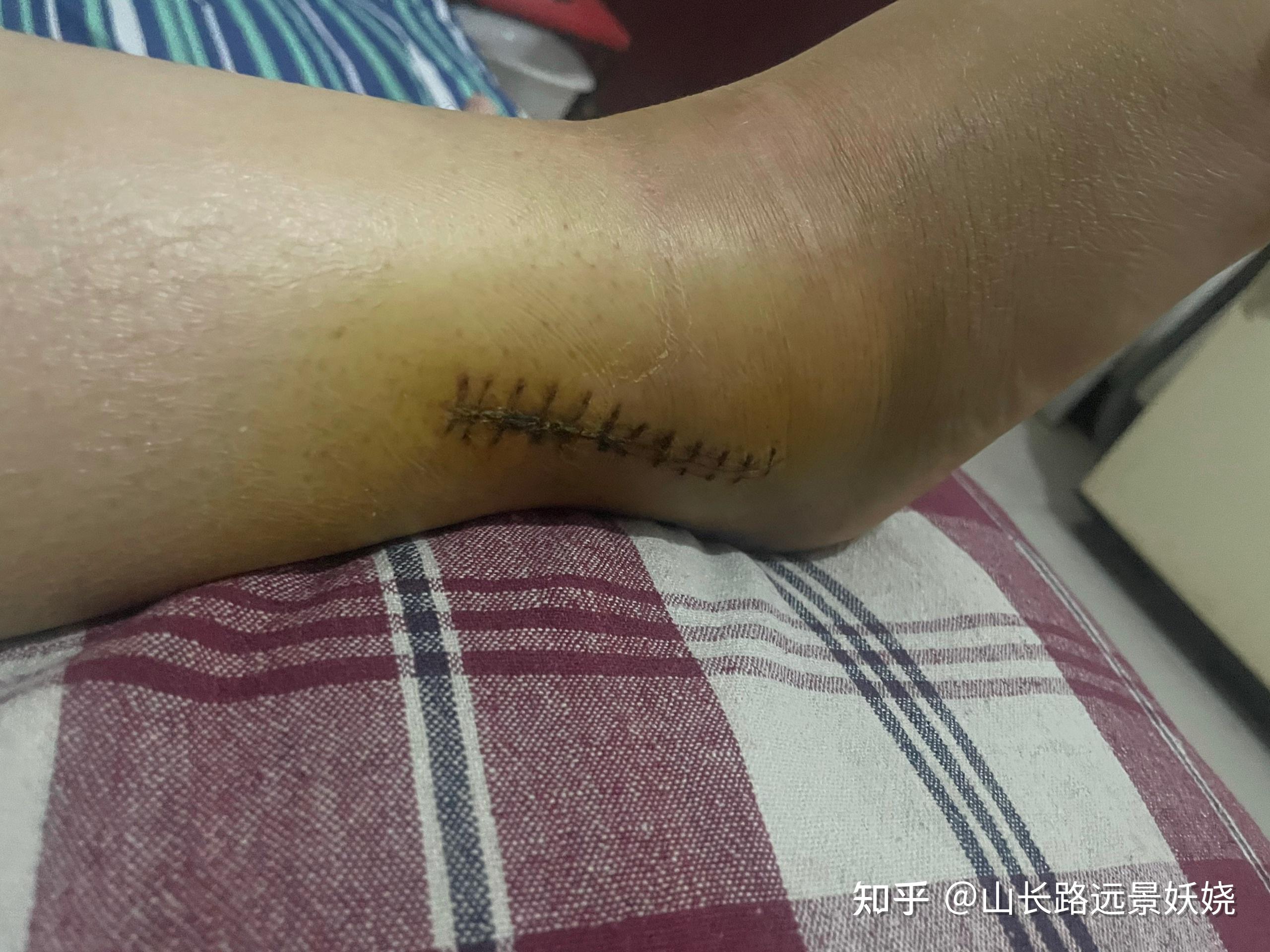 讀研期間右腳腳踝雙踝骨折康復(5.7手術) - 知乎