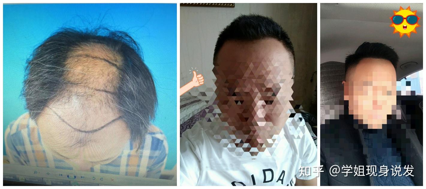 植发十年了，来看看植发效果怎么样！为什么有的人植发后三五年就掉光了？植发到底能管多久？植发效果和什么有关？ - 知乎
