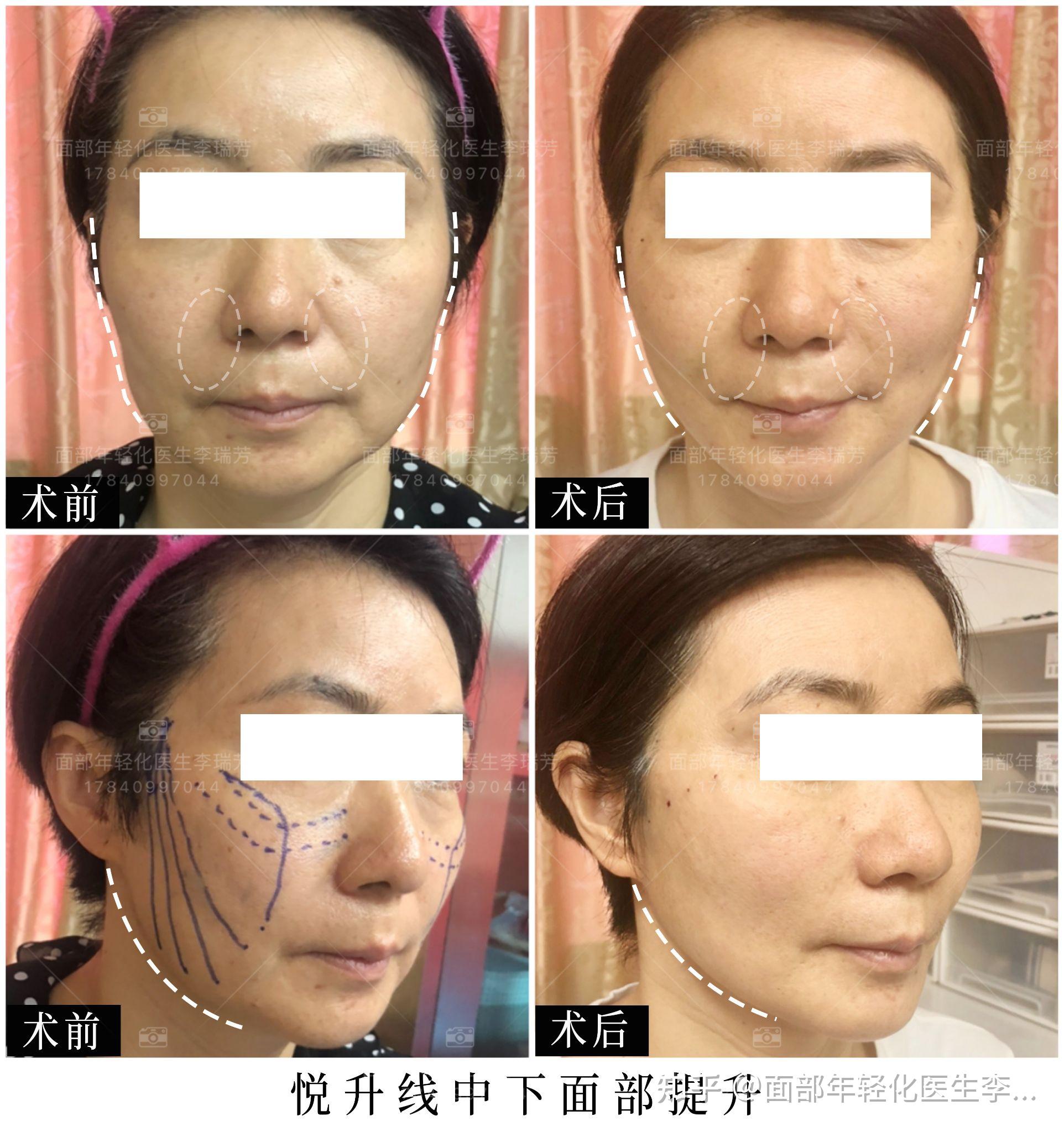 面部松垮丫头选择用悦升线