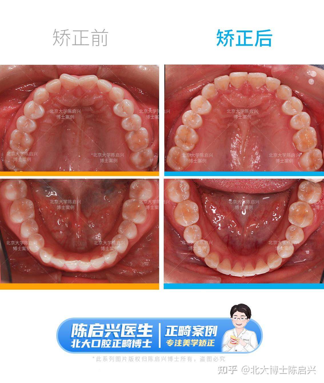 隐适美矫正门牙扭转案例,绽放完美微笑 - 知乎