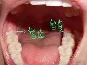 你身边有不长智齿的朋友吗 为什么有人不长智齿 是不是不正常 知乎