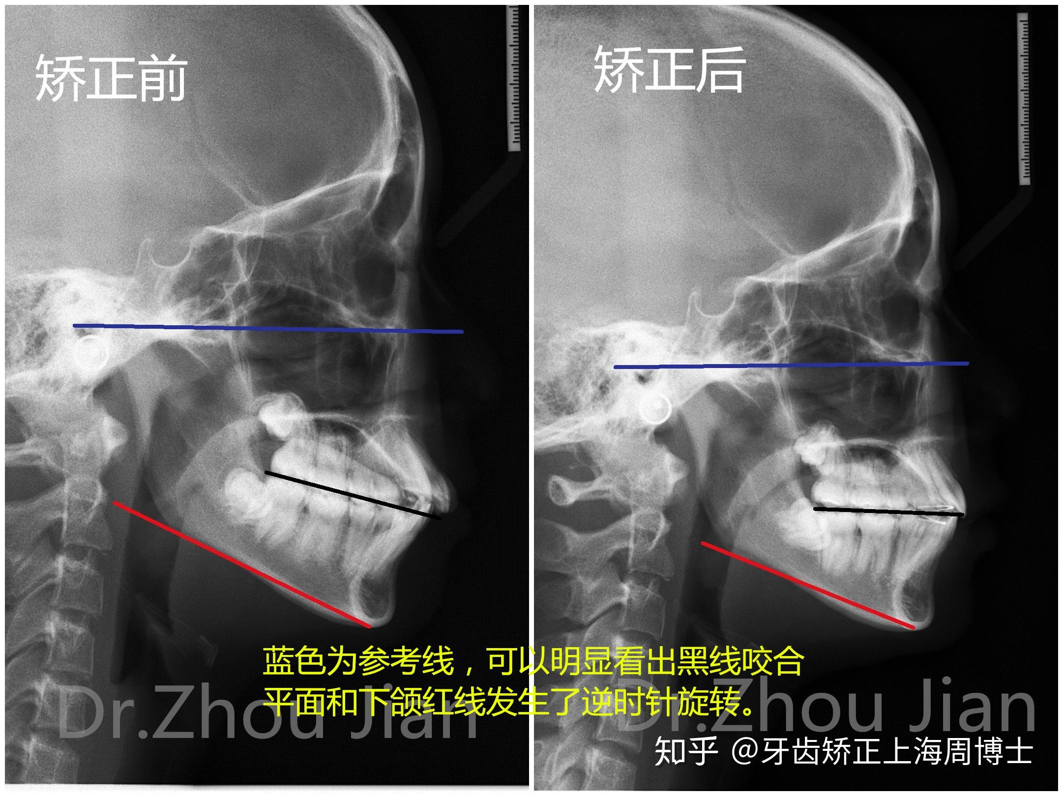 周博士矯正案例2:16歲的小姑娘,下頜後縮,上頜前突露牙齦,拔除蛀掉的