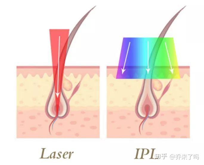 脱毛仪脱毛原理