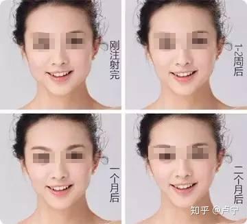 瘦脸针打一针有效果吗_瘦脸针打多少单位合适_瘦脸针怎么打