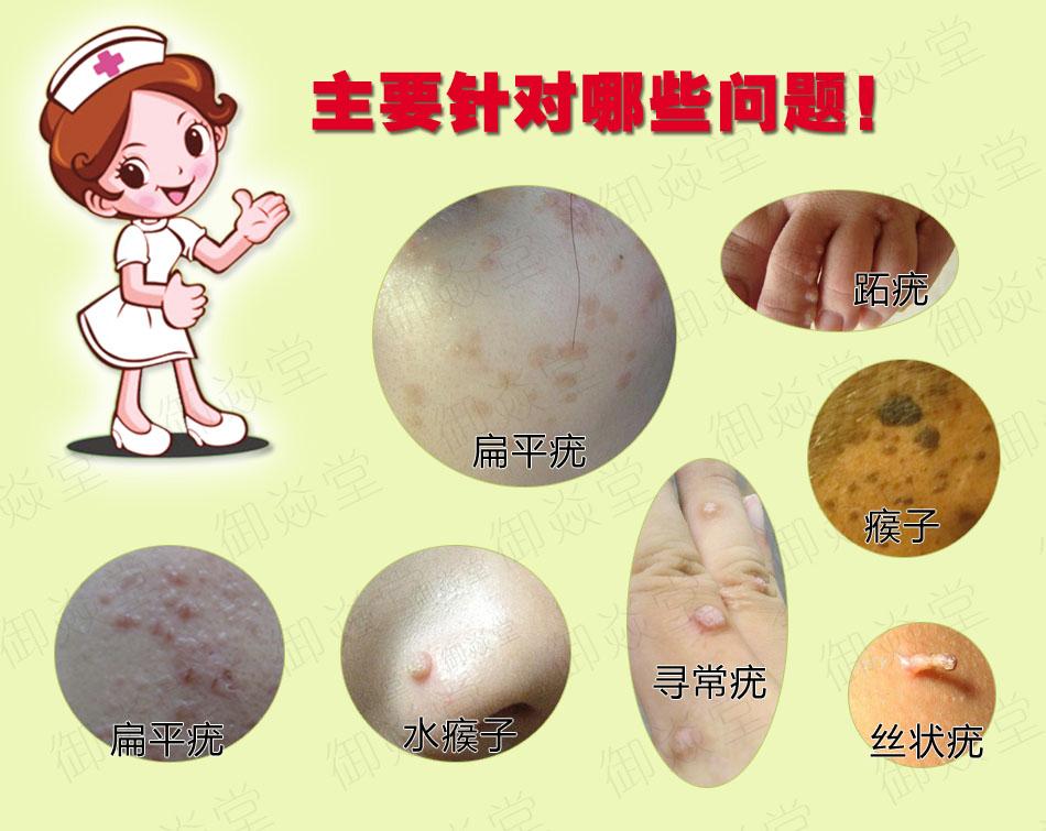 病毒疣的种类有哪些?如何治疗? - 知乎