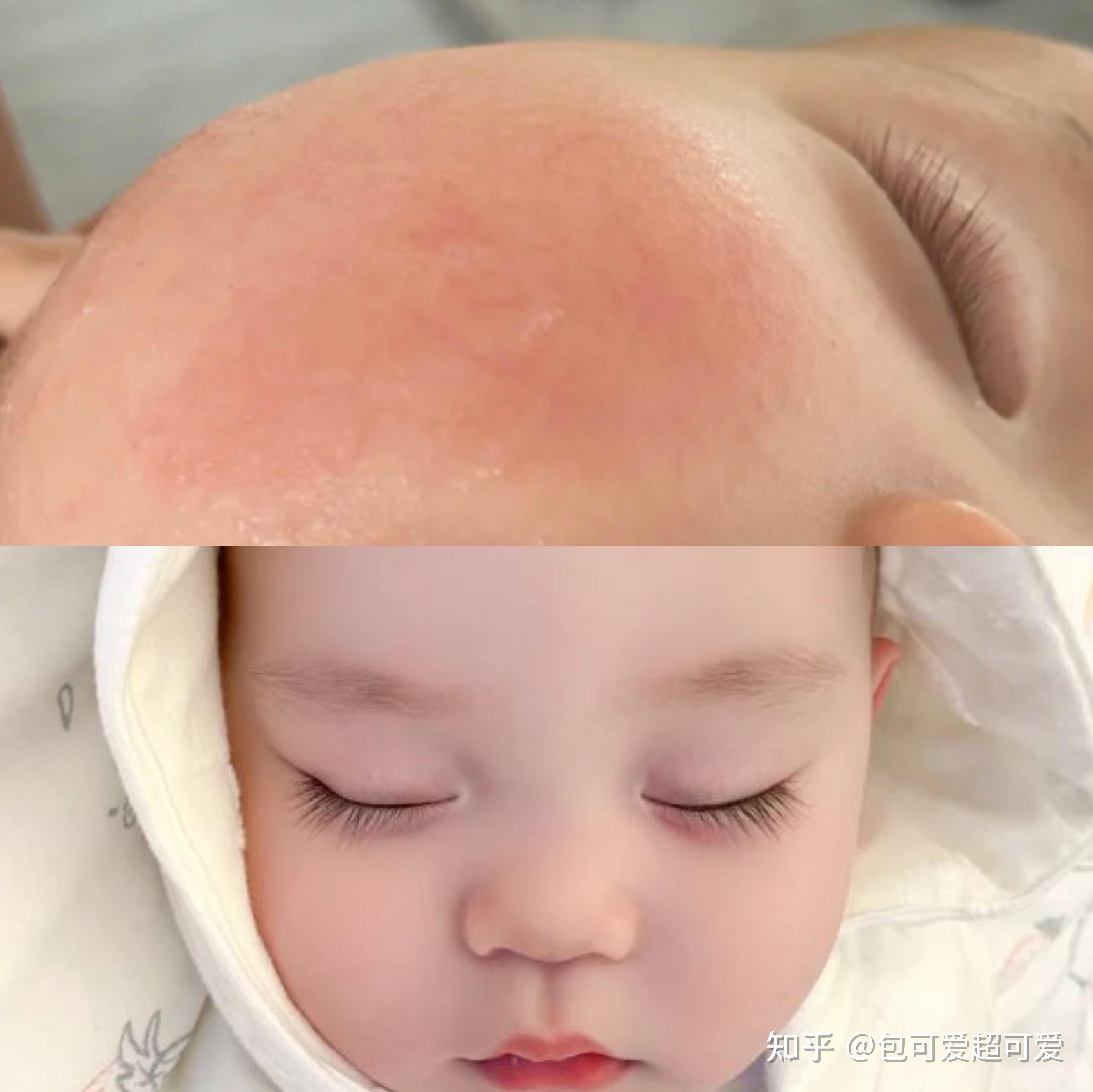 宝宝冬天红脸蛋不是可爱，可能暗示着这些症状！
