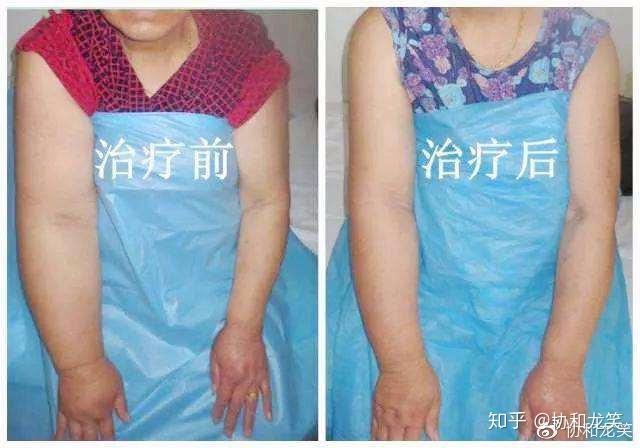 乳腺癌術後常見併發症淋巴水腫bcrl