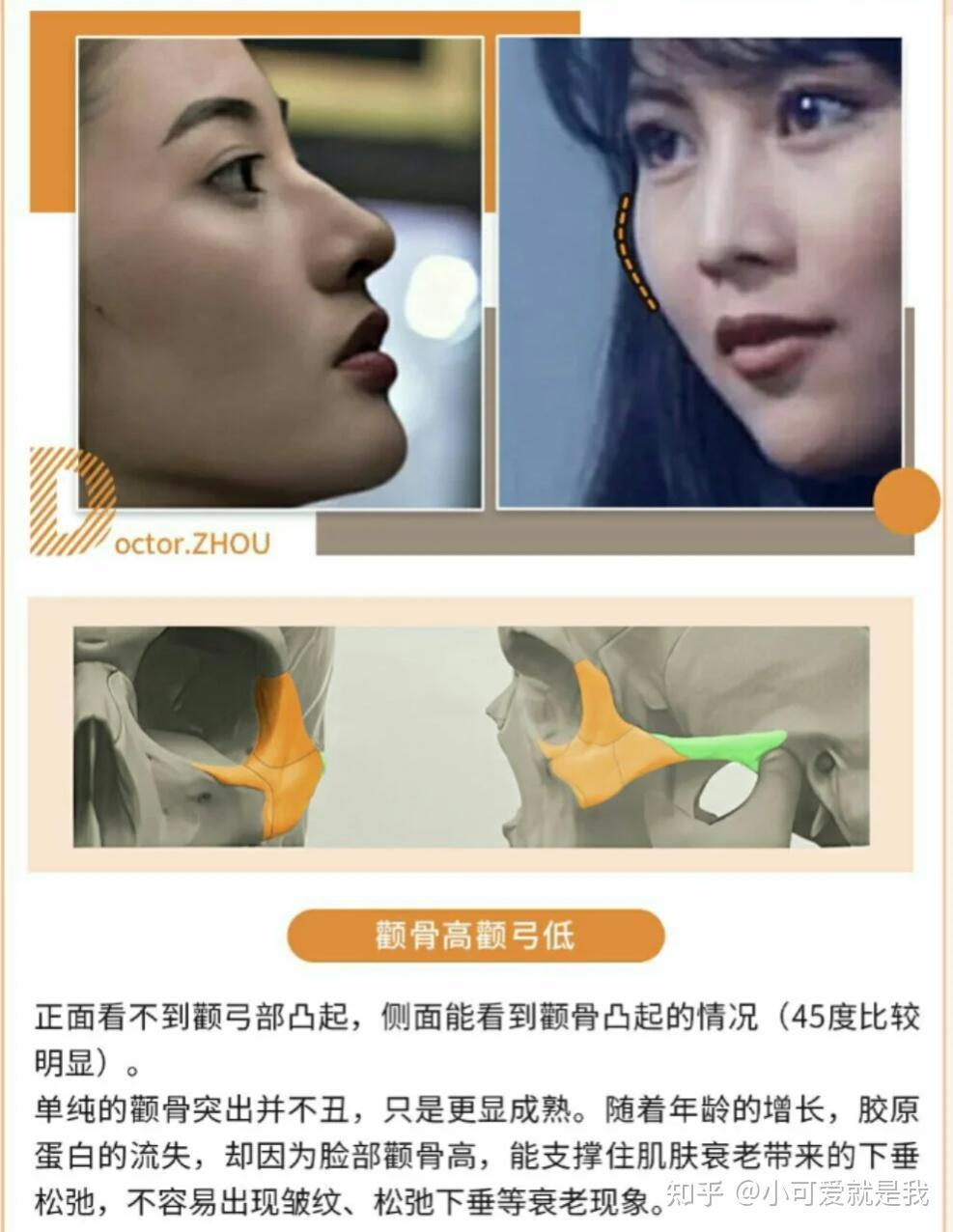 何晋龙解读:骨相美的关键颧骨vs颧弓 - 知乎