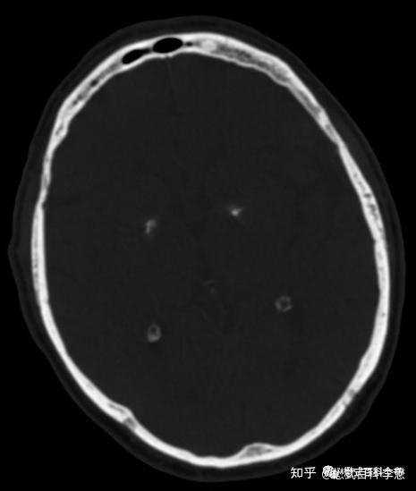 苍白球钙化的影像表现