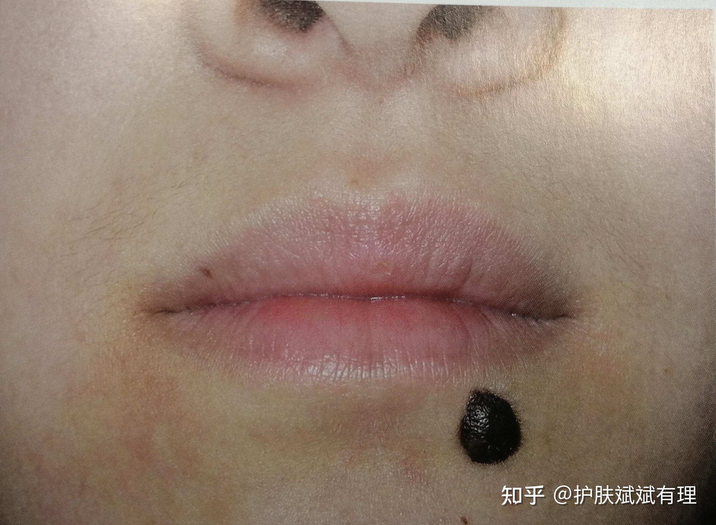 交界痣在这里我们并不讨论桃花痣,美人痣,媒婆痣之类的面相学问题