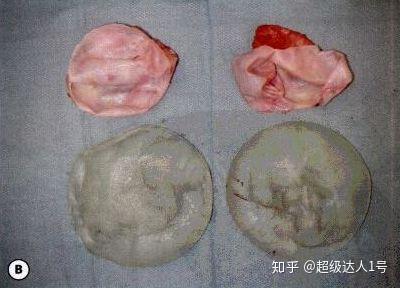 做假体隆胸一定会出现包膜挛缩吗症状及判断方法