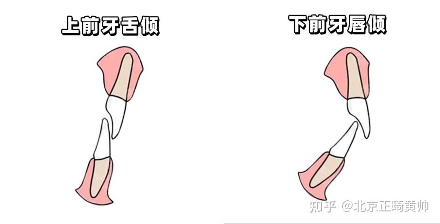 为什么牙齿矫正要调整牙齿角度？因为这几种牙齿角度会影响面型！ - 知乎