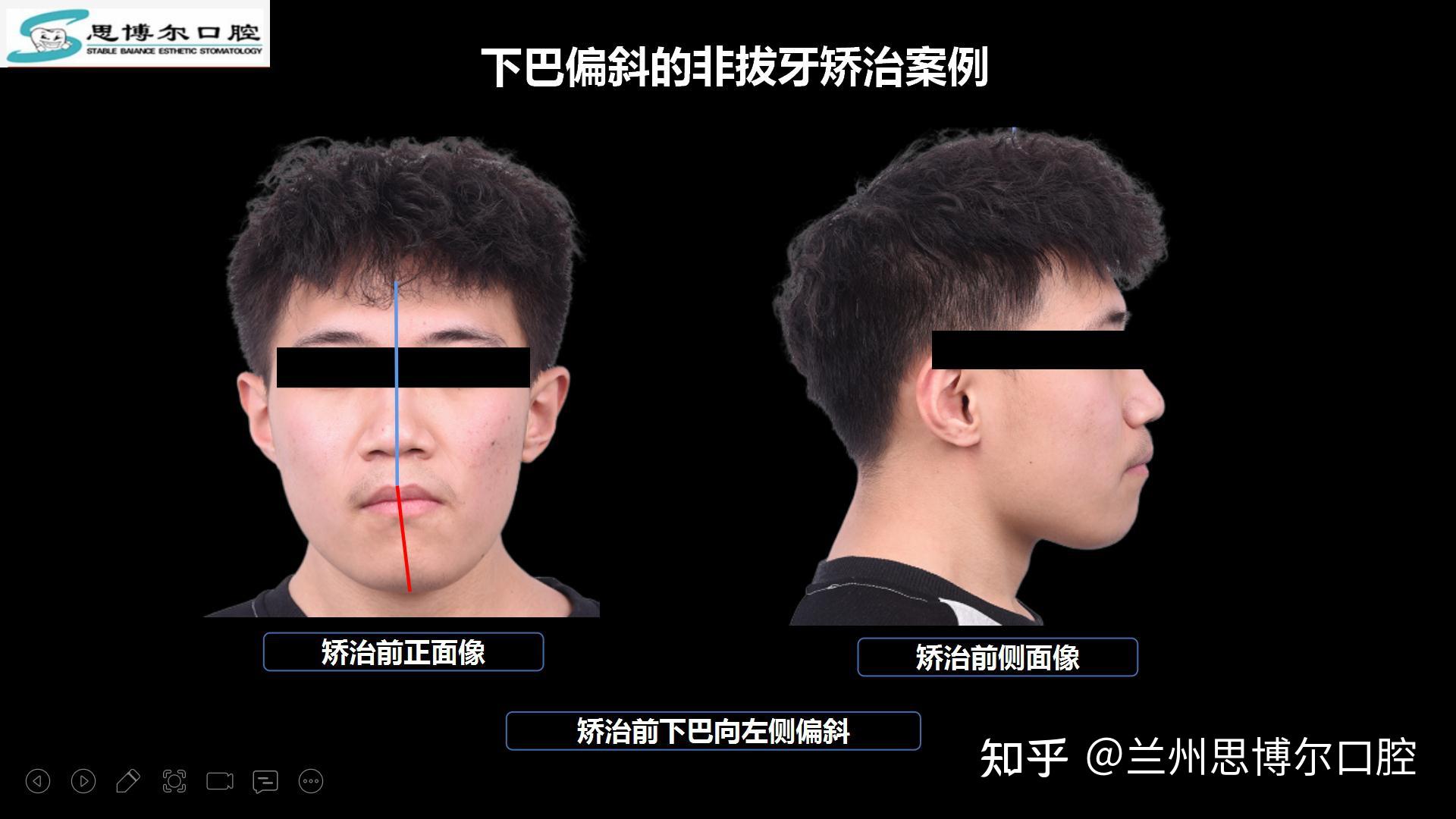 颏部偏斜的非手术矫治案例 - 知乎