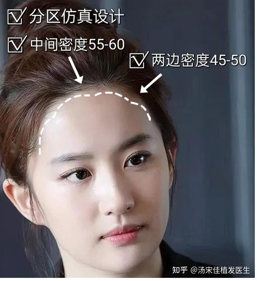 发际线种植方法和注意事项 - 知乎