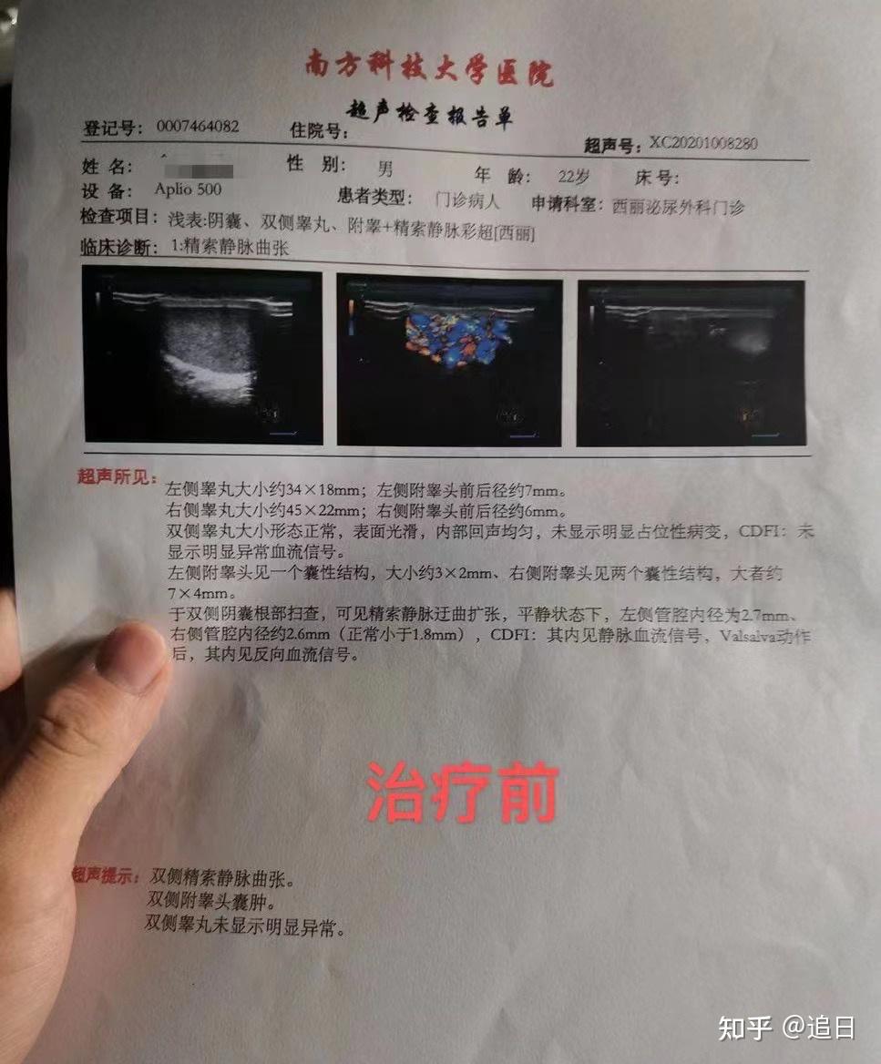 慢性附睾炎该怎么治疗