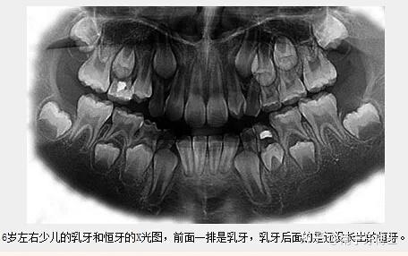 發展為根尖炎,炎症引起牙根與牙槽骨粘連,造成乳牙牙根吸收不完全或沒