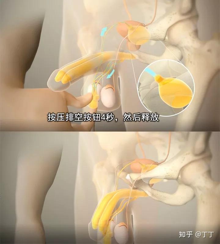 女人可以植入假体丰胸那男人是否也可以植入什么增大阴茎呢