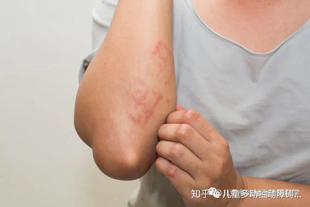 吃鱼油也会过敏多动抽动障碍补充鱼油过敏怎么办