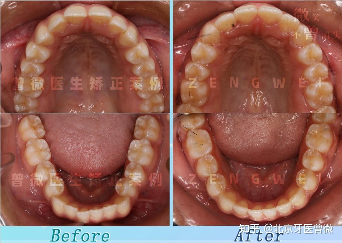 對刃關係導致的牙齒反頜(地包天),金屬託槽不拔牙矯治 - 知乎