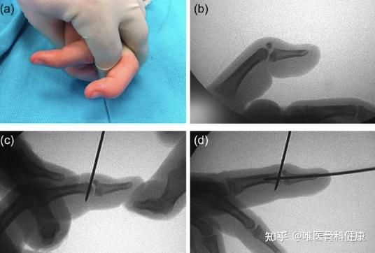 针对早期的和不伴有骨折或轻微无移位骨折的"锤状指",优先选择保守