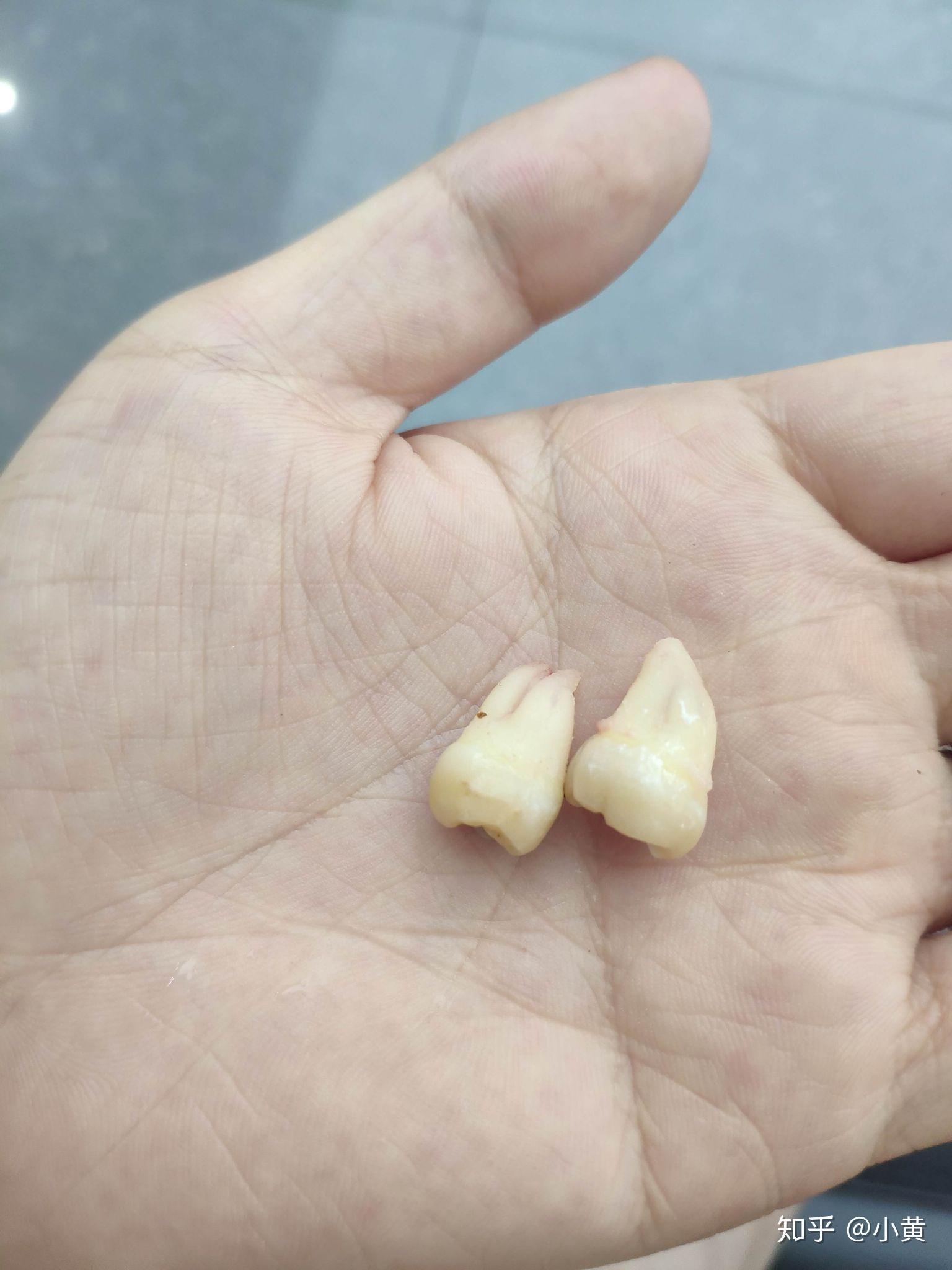 智齿长得很好即正位不痛是什么体验