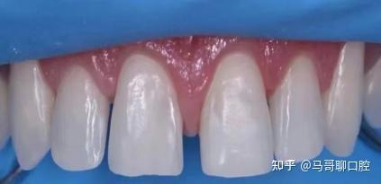大门牙有缝,这是咋回事? - 知乎