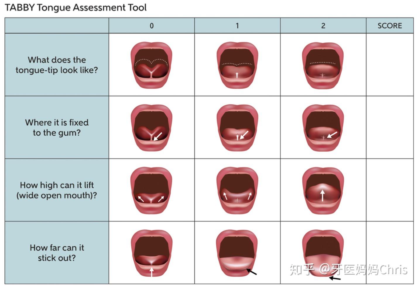 成年患者牙齿矫正伴有舌系带过短的医学科普—程德盛牙齿整形博客