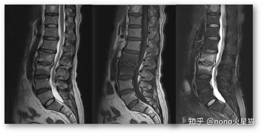 【影像笔记】少见的骨病:布氏杆菌性脊柱炎