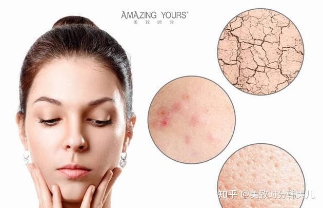 混合性皮肤特征美致时分