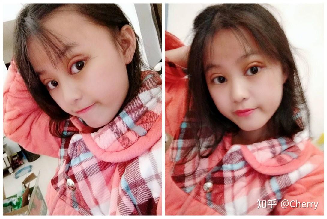 重庆小妹子割双眼皮术后90天分享焕然重生