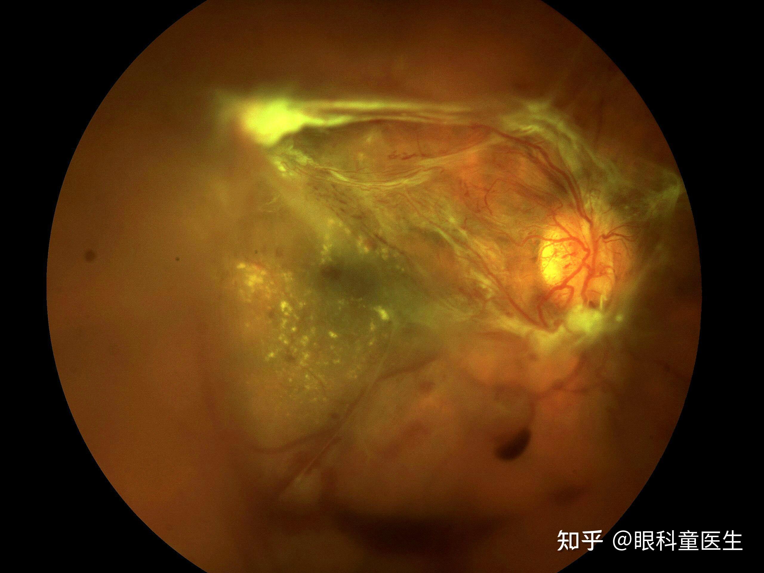 【图片赏析】五种眼底成像下的视网膜脱落_黄斑_病变_诊断