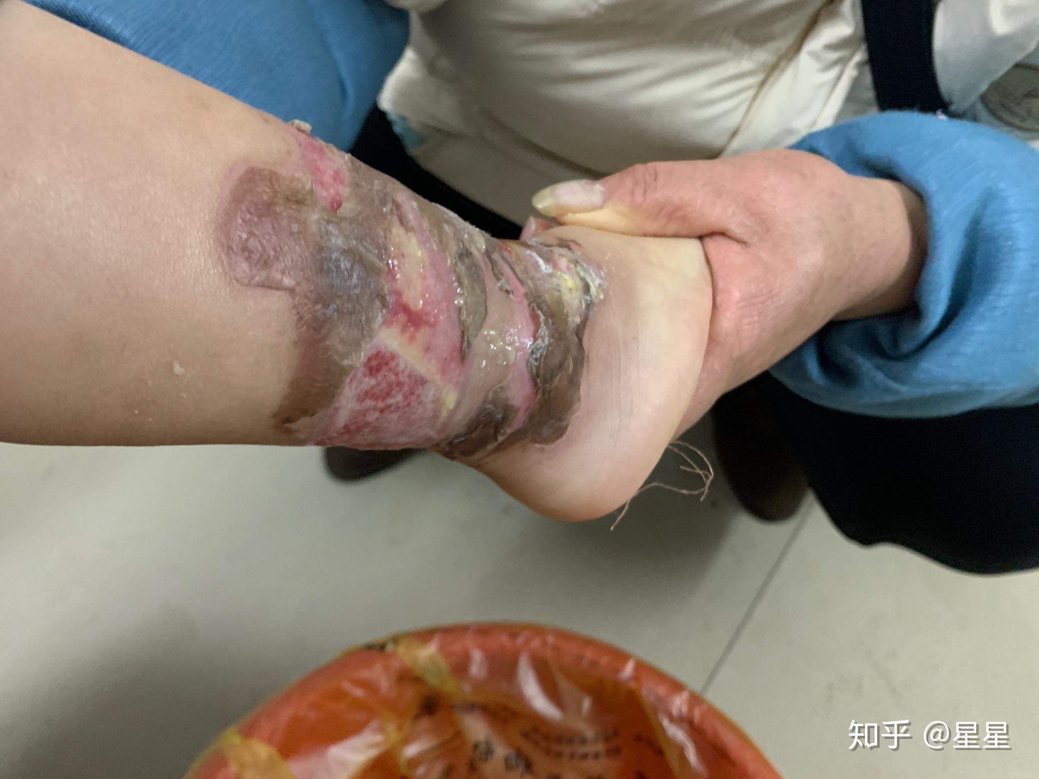 两岁宝宝深二度烫伤,会留疤吗 - 知乎