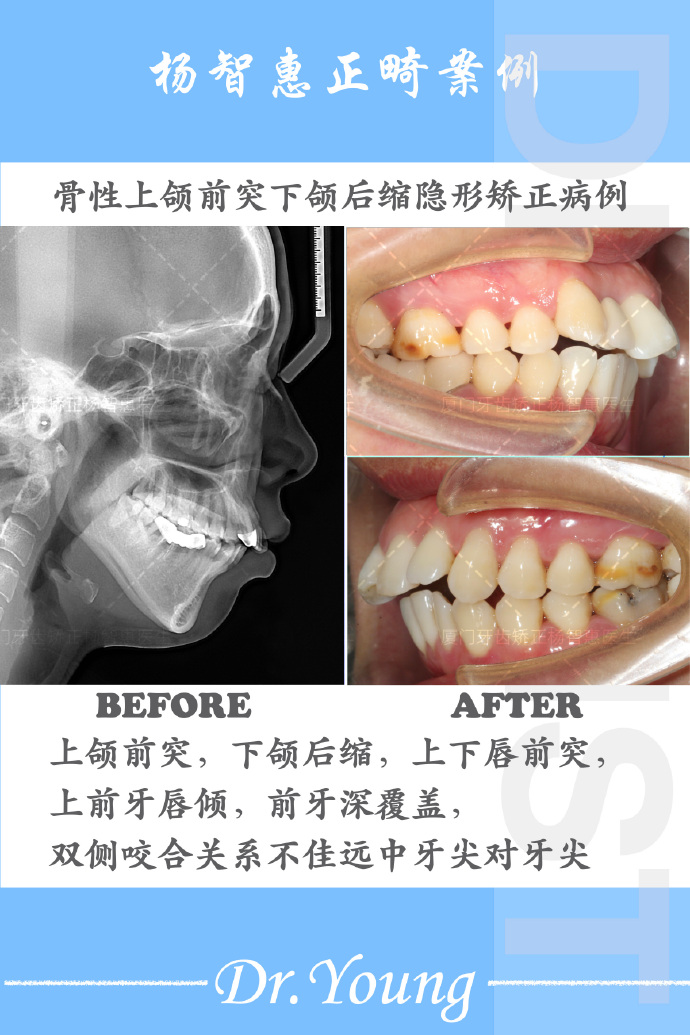 上颌后缩图片