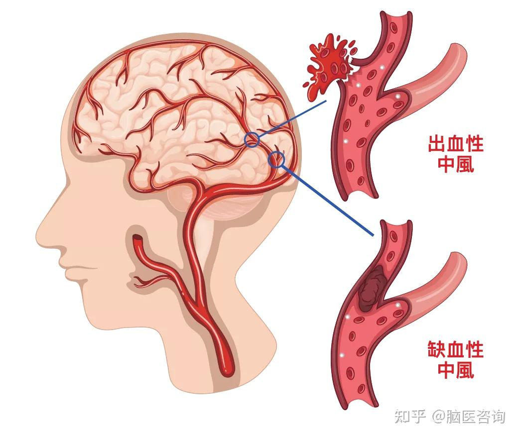 冬天来了更要时刻提防脑卒中