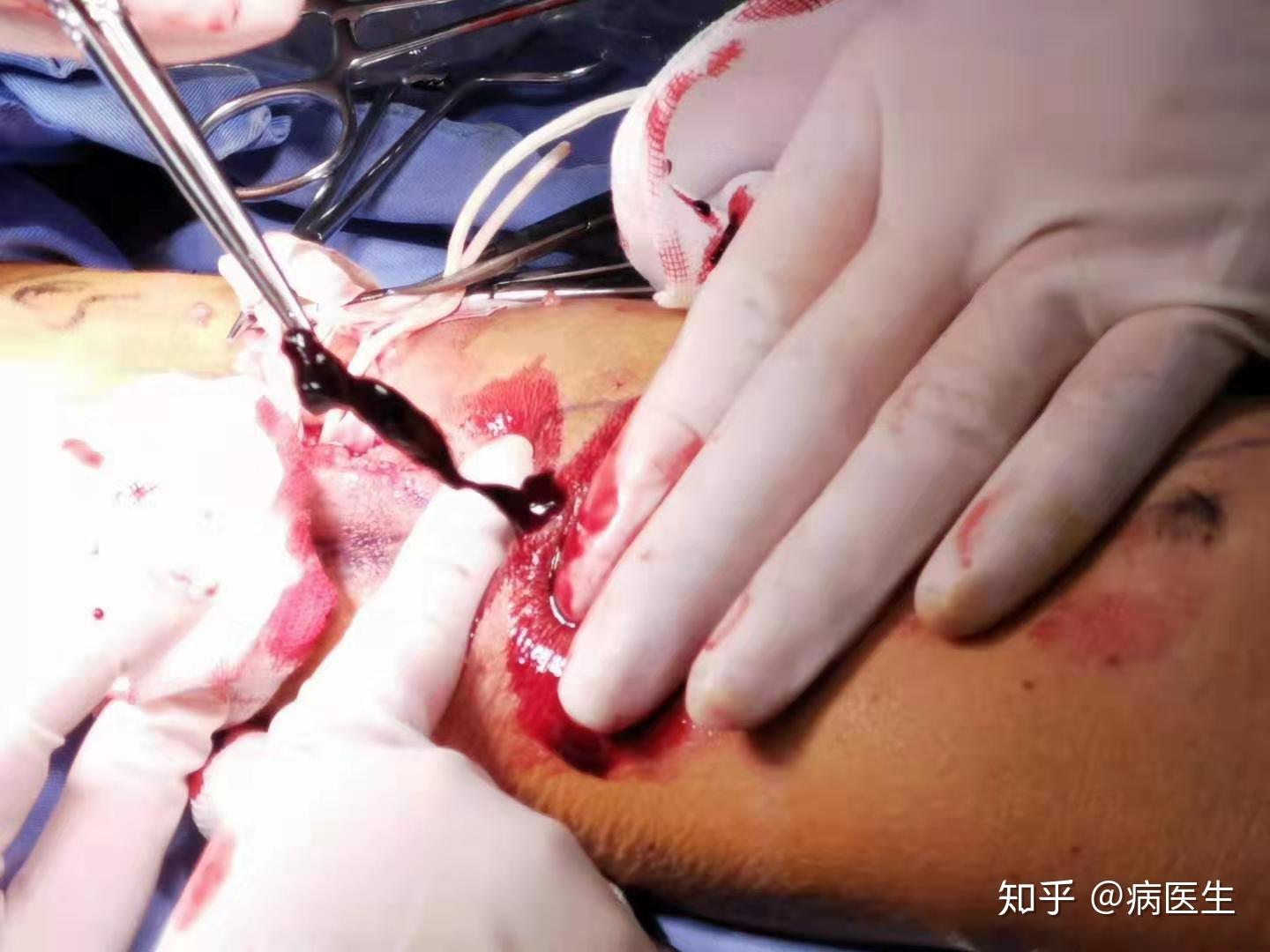 血管瘤血栓——小切口切开取栓