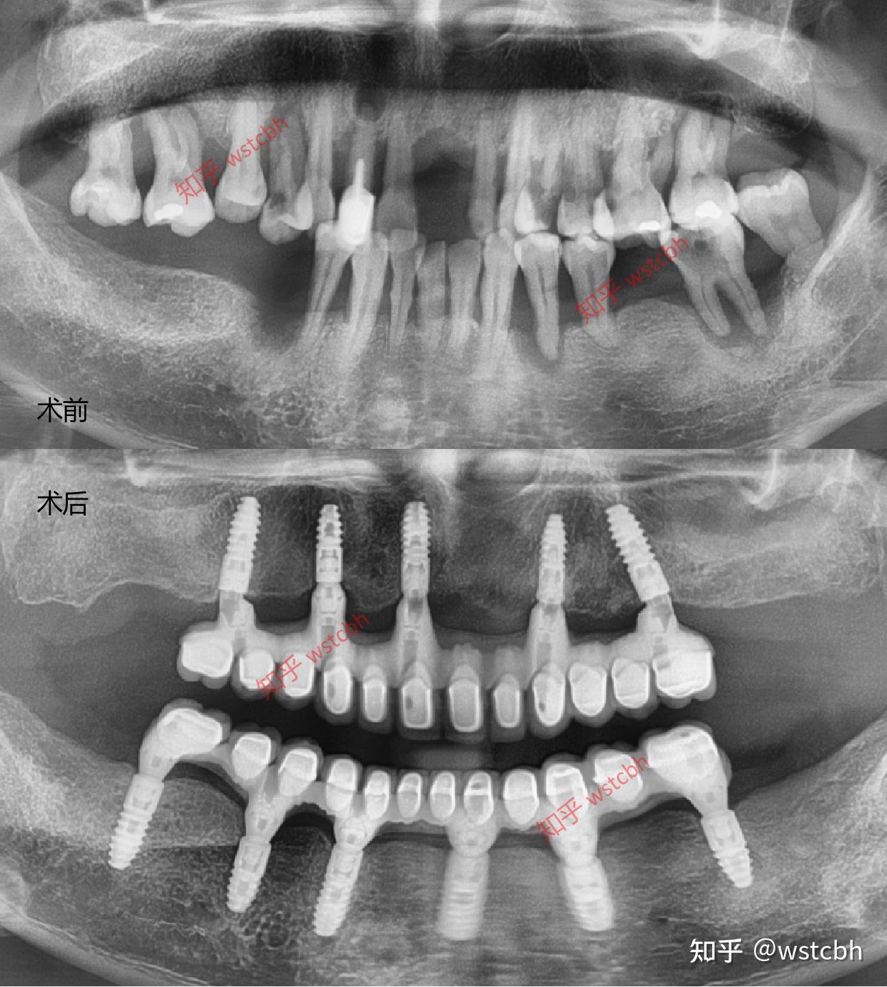 超复杂案例｜骨性反颌、多颗牙缺失、乳牙滞留、畸形牙...怎么处理？！ - 知乎