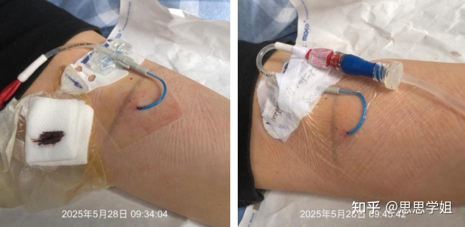 PICC 穿刺点渗血,这 3 种情况需要立即更换敷贴 - 知乎