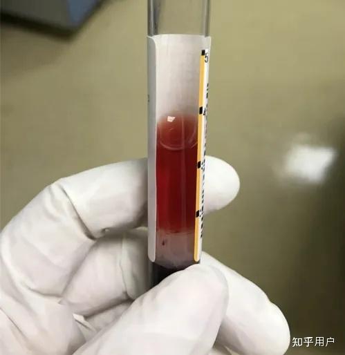 干货分享!血液样本的溶血、脂血、胆红素和维生素C对生化检测结果的影响 - 知乎