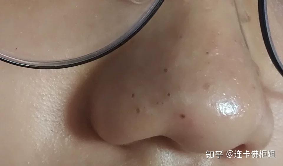 请问鼻子上这种大黑头该怎么处理