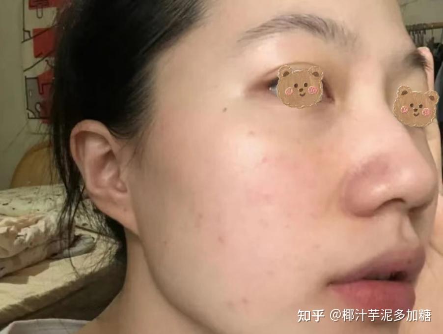 出去玩晒黑了怎么办?有什么快速恢复的办法吗?