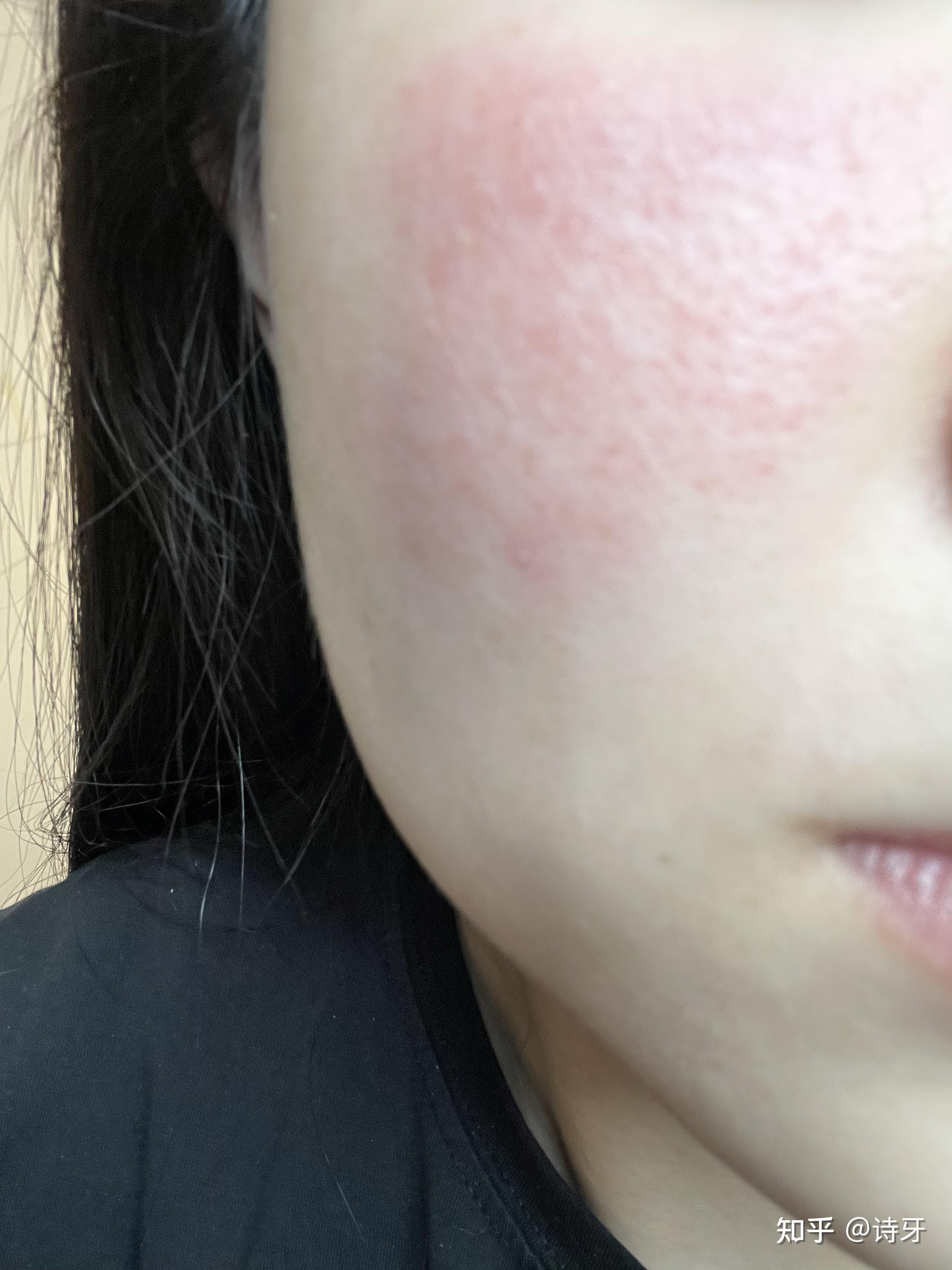 脸上突发过敏性皮炎、湿疹，走上为时两周的求医之路，奉劝大家不要急不要走冤枉路。如果正在经历我所经历的，可以进来看看～当做参考 - 知乎