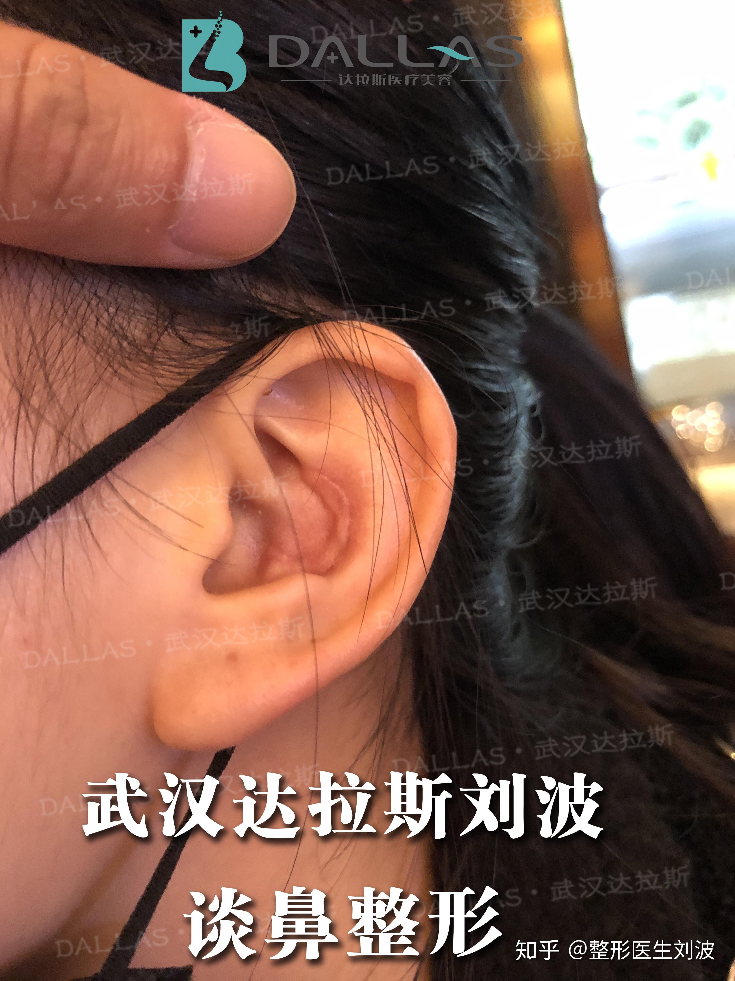 为什么耳软骨有的在前面取走的在后面取前面留疤多丑啊
