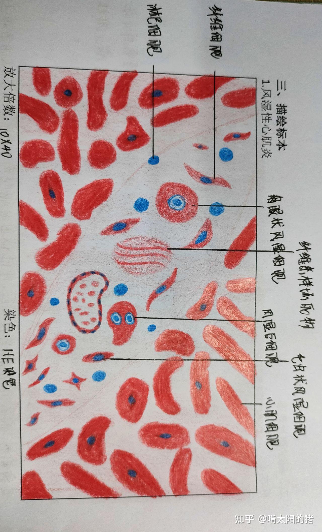 病理学红蓝铅笔手绘图