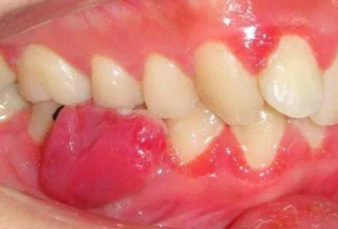 牙龈长红色肉疙瘩图图片
