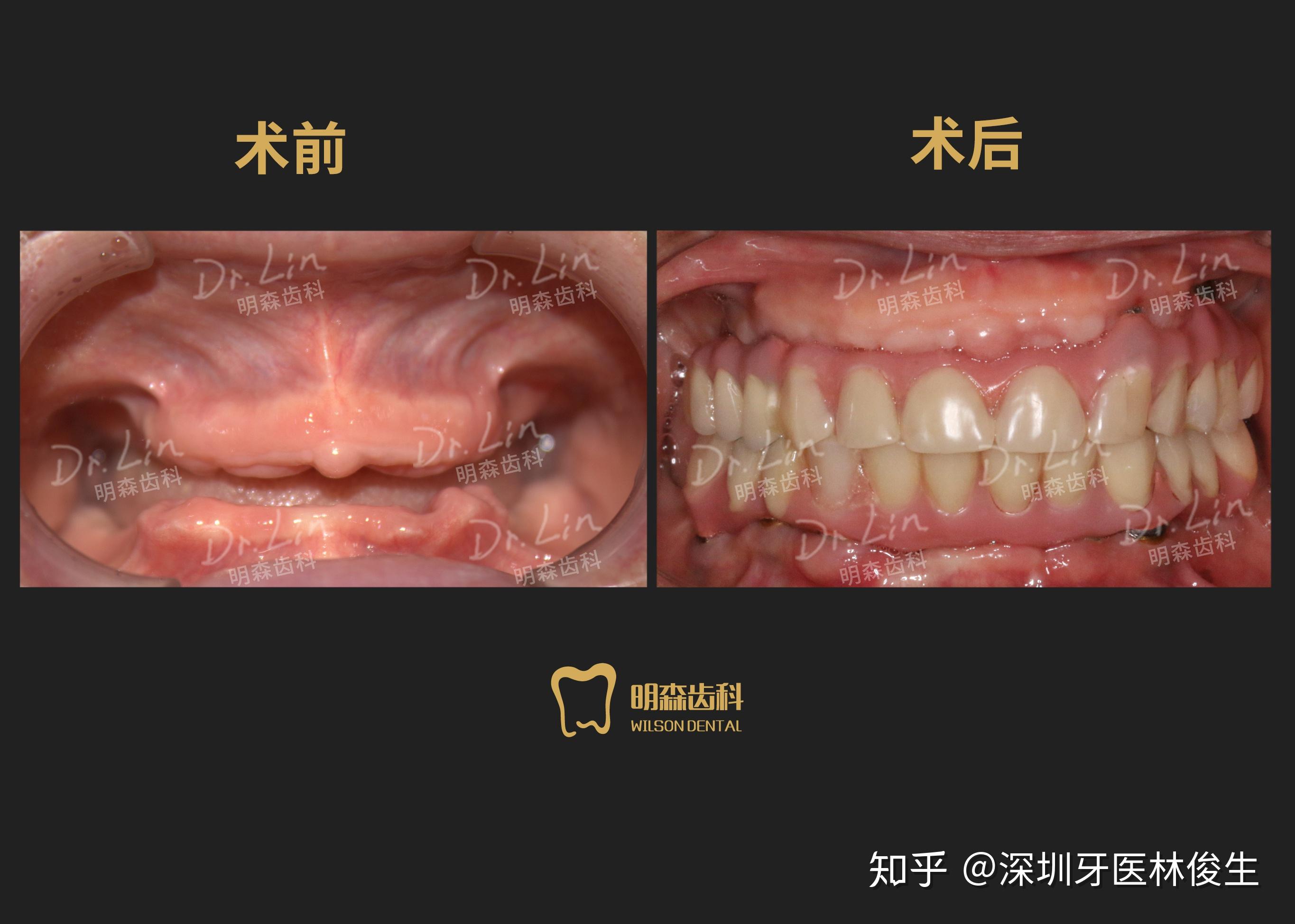 你们想要的全口半口种植牙案例来了