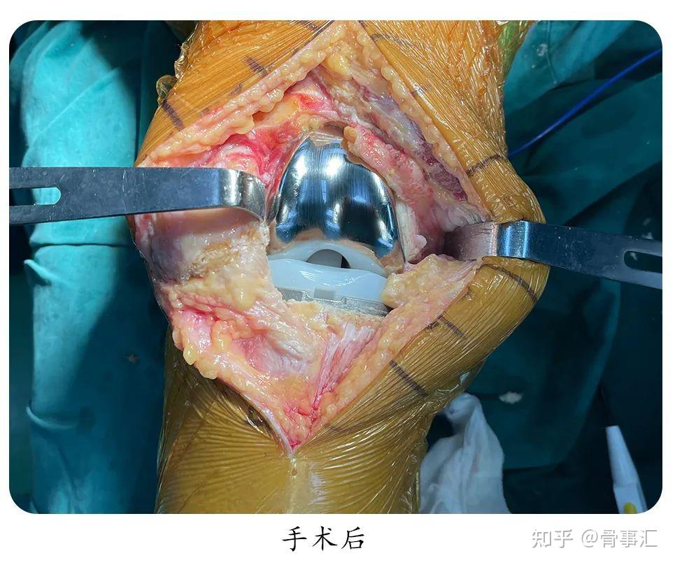 人工膝关节置换术是要把整个膝盖的骨头切掉吗