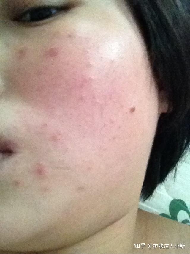 皮肤干燥脱皮:壬二酸本身有控油的作用,所以如果没有做好保湿,皮肤