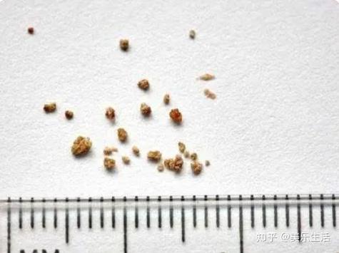 胆结石形成的原因有哪些 知乎