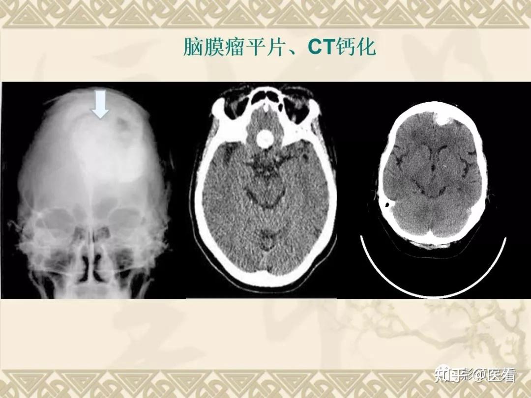 贺晓生教授谈儿童脑瘤:儿童四脑室室管膜瘤手术 - 微医（挂号网）