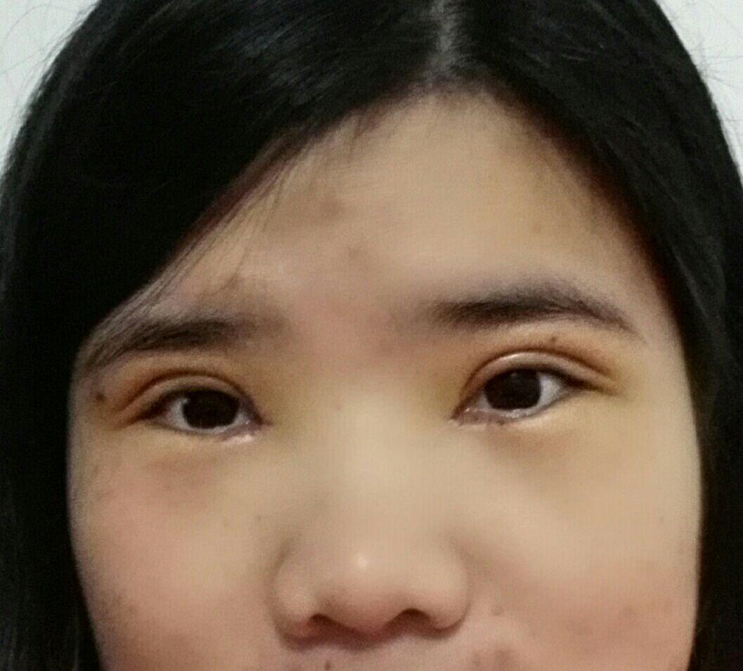 割双眼皮有什么危险吗？
